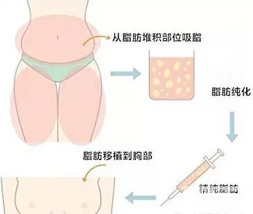 玻尿酸vs自体脂肪填充该怎么选 图片-5