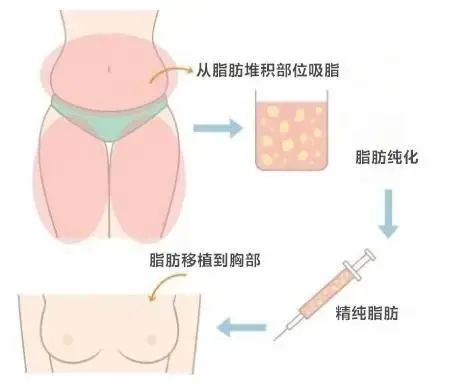 自体脂肪丰胸丨 让多余的肉肉去到对的地方! 图片-8