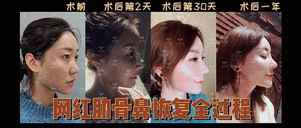 沈阳杏林整形鼻综合案例 图片-12