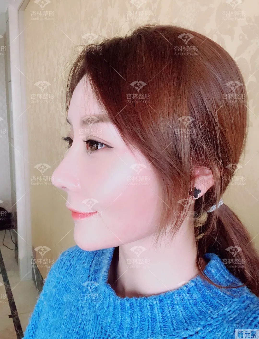 沈阳杏林整形鼻综合案例 图片-15