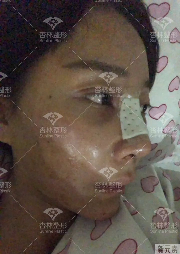 沈阳杏林整形鼻综合案例 图片-14