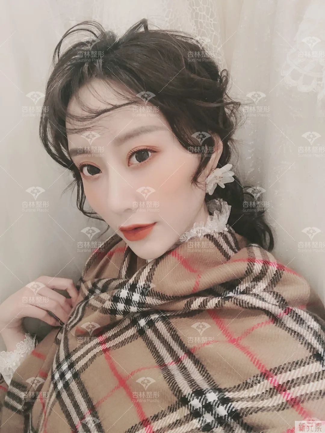 沈阳杏林整形鼻综合案例 图片-18