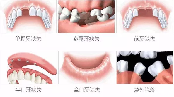 缺牙多年，还能种牙吗? 图片-11
