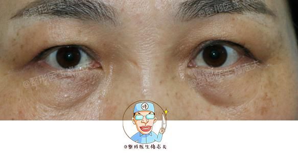 眼袋和卧蚕有什么区别?怎么祛眼袋? 图片-2