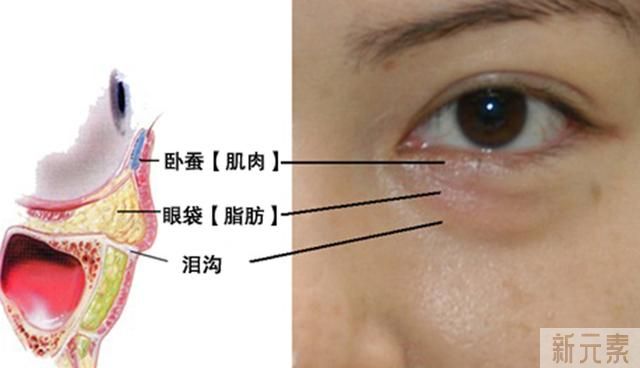 眼袋和卧蚕有什么区别?怎么祛眼袋? 图片-3