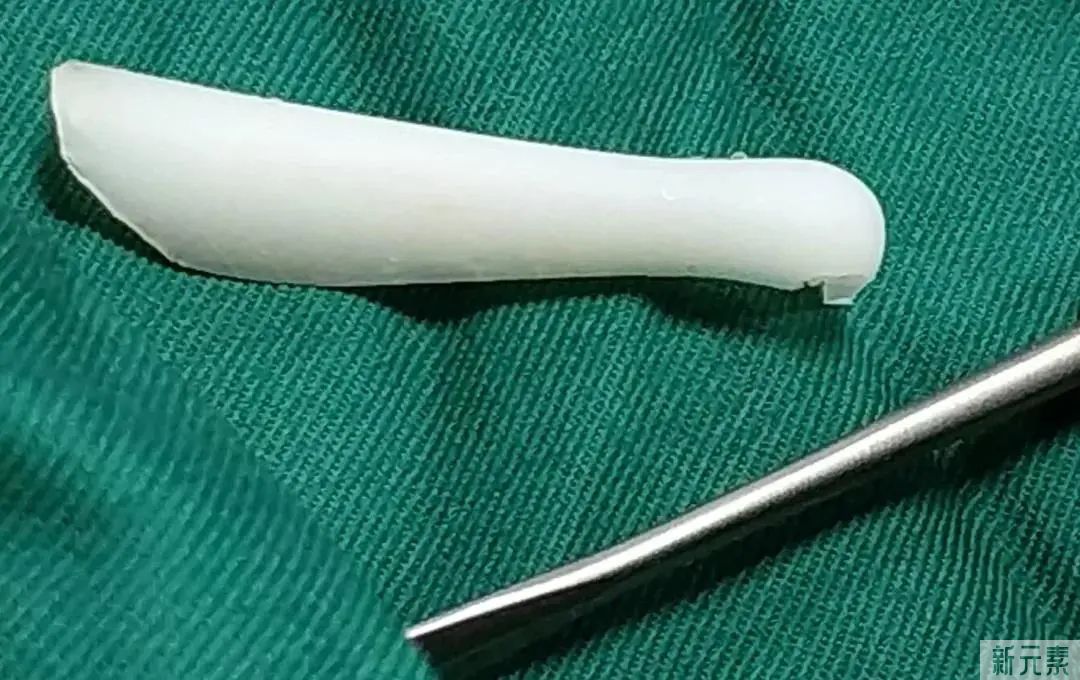 做过的鼻子，变老之后还会下垂变形吗? 图片-8
