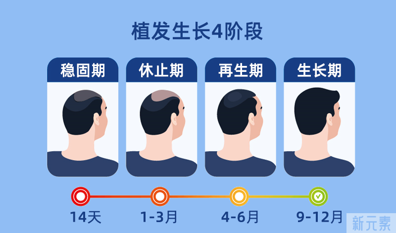 植发后，多久能长出新发?多久能看到效果? 图片-2