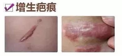从颜色就能判断疤痕增生程度!来看看自己处于哪个阶段了 图片-2