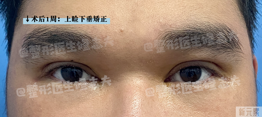 那些来做修复的双眼皮，最后怎么样了? 图片-3