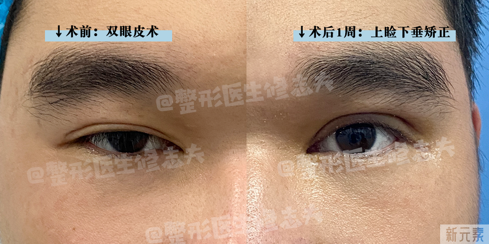 那些来做修复的双眼皮，最后怎么样了? 图片-4