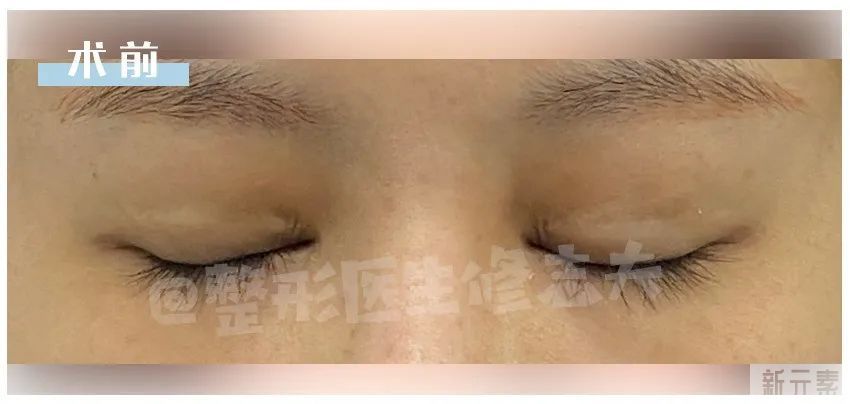 那些来做修复的双眼皮，最后怎么样了? 图片-6