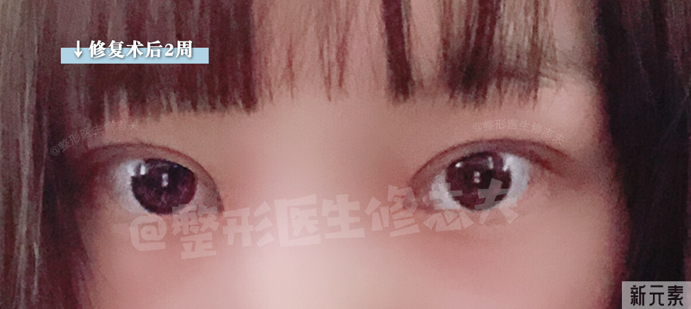 那些来做修复的双眼皮，最后怎么样了? 图片-10