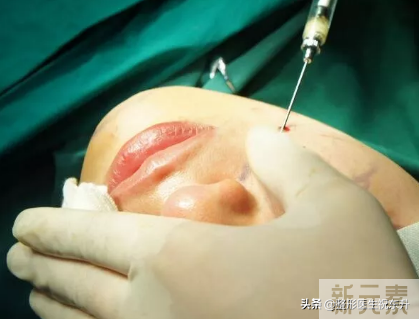 脂肪填充的危害:最坏的结果是什么?  是栓塞!   图片-1