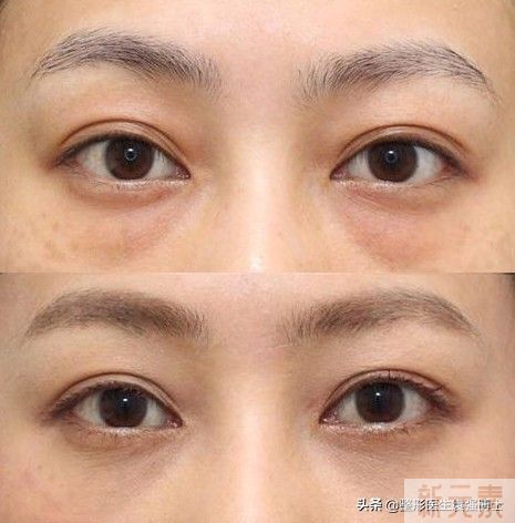 把眼袋做了，局麻体验难忘，中途还闻到了烤肉味......   图片-1