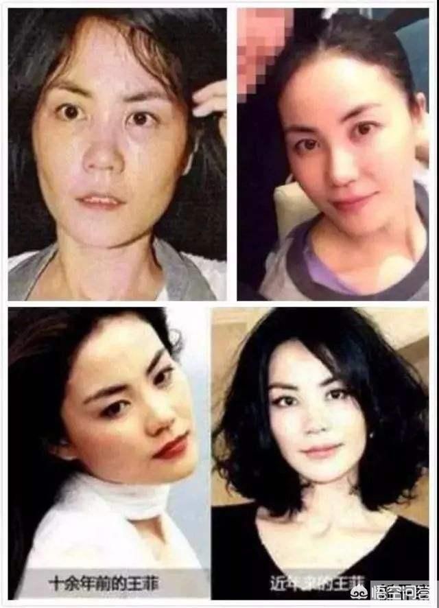 线雕瘦脸可以维持多久?效果怎么样? 图片-1