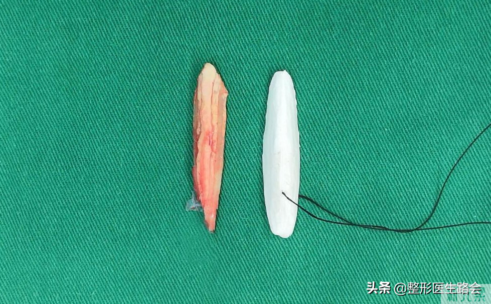 医生，你没有职业道德?膨体隆鼻在国外都被禁了!你还推荐? 图片-8