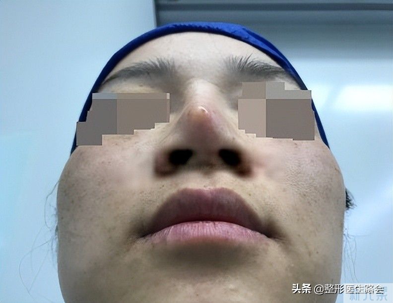 医生，你没有职业道德?膨体隆鼻在国外都被禁了!你还推荐? 图片-15