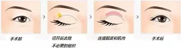 听说你要做双眼皮修复，这里有干货 图片-1