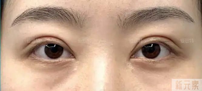 双眼皮太宽、太假、不对称，居然修复成了这样!! 图片-4