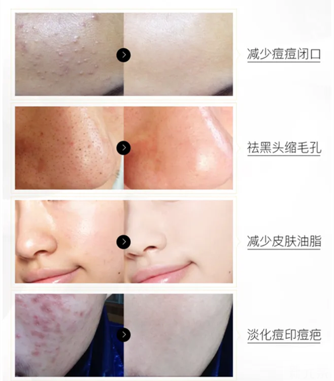 “刷酸”焕肤的正确打开方式! 图片-5