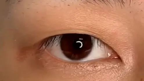 割完双眼皮，去掉的脂肪会继续长出来吗? 图片-5