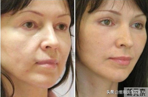 肉肉脸和瘦凹脸，皮肤松弛怎么选择抗衰项目? 图片-1