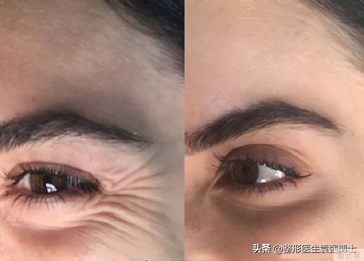 40岁后还想年轻，选对医美项目才能高效抗衰(尤其最后一个) 图片-3