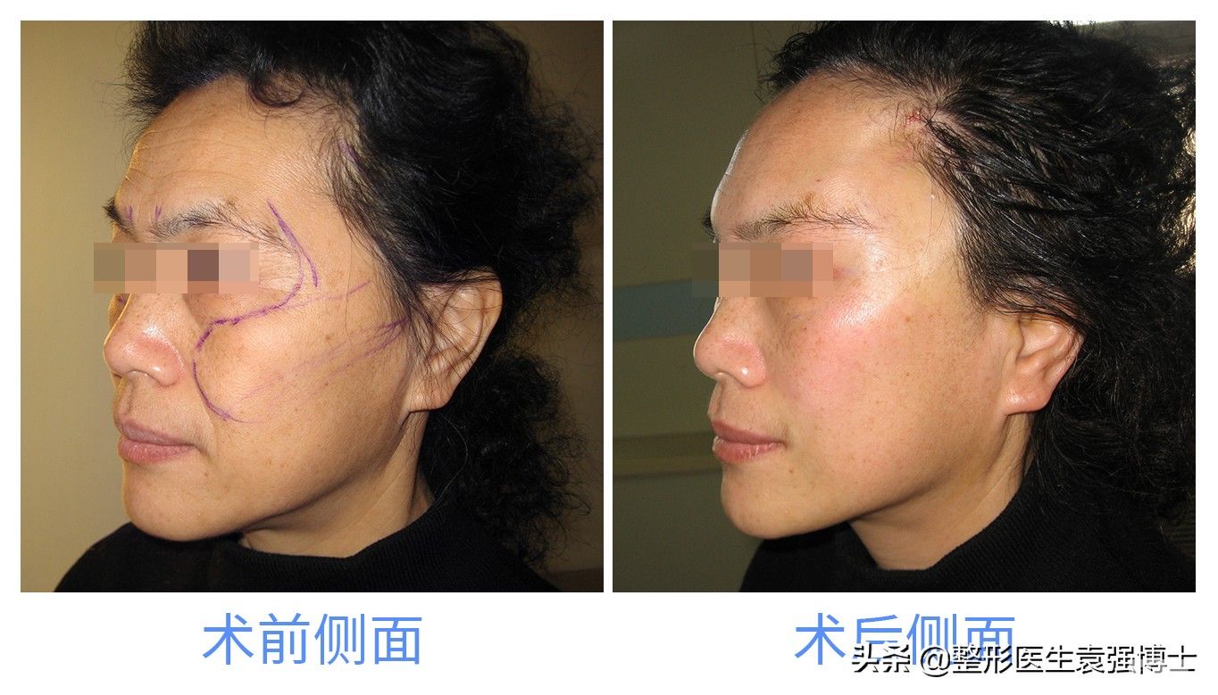 40岁后还想年轻，选对医美项目才能高效抗衰(尤其最后一个) 图片-6