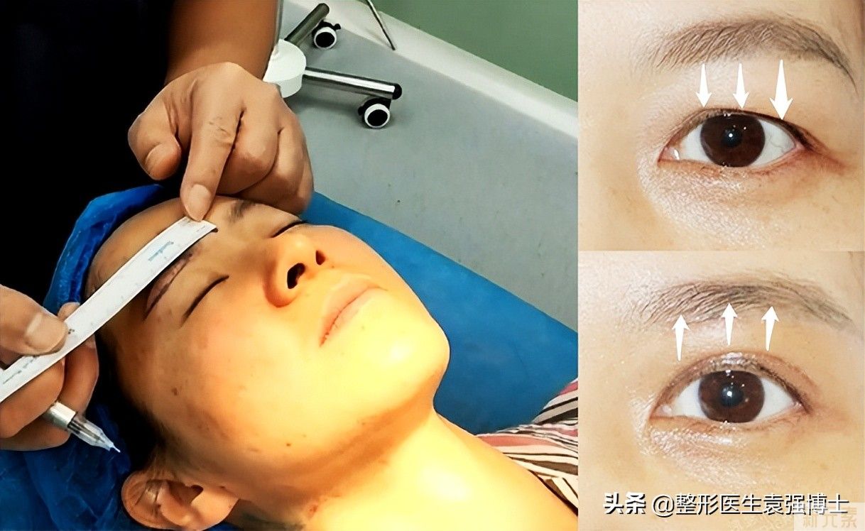 40岁后还想年轻，选对医美项目才能高效抗衰(尤其最后一个) 图片-7