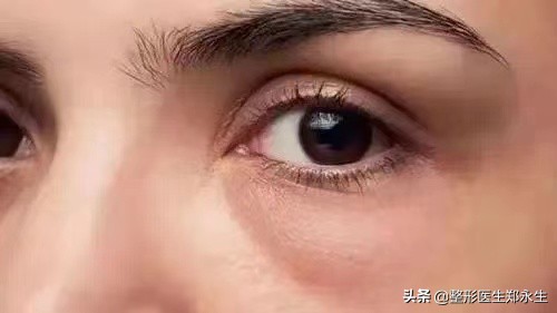 科普|眼袋一般分为假性眼袋和真性眼袋 图片-3