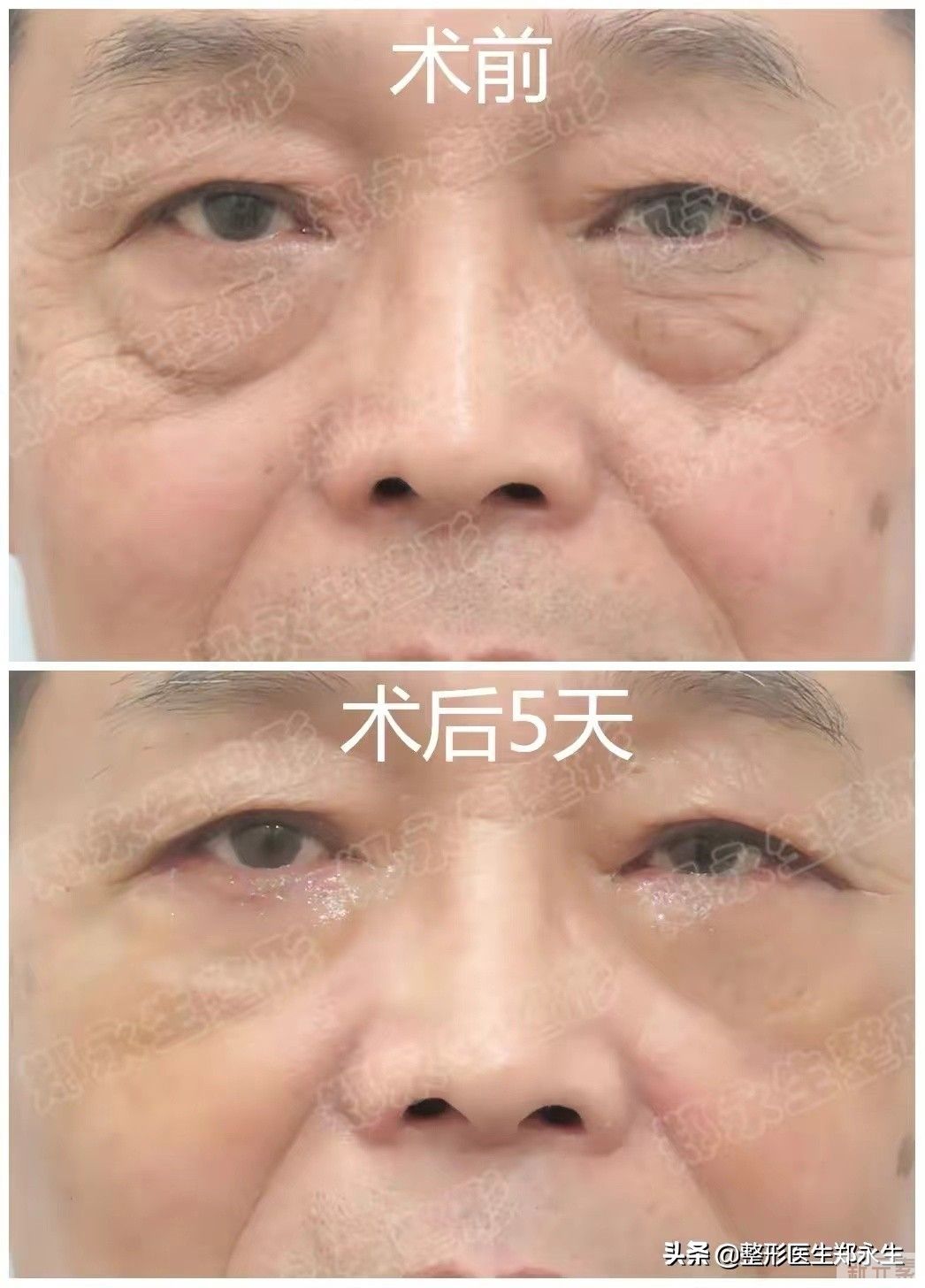 科普|眼袋一般分为假性眼袋和真性眼袋 图片-4