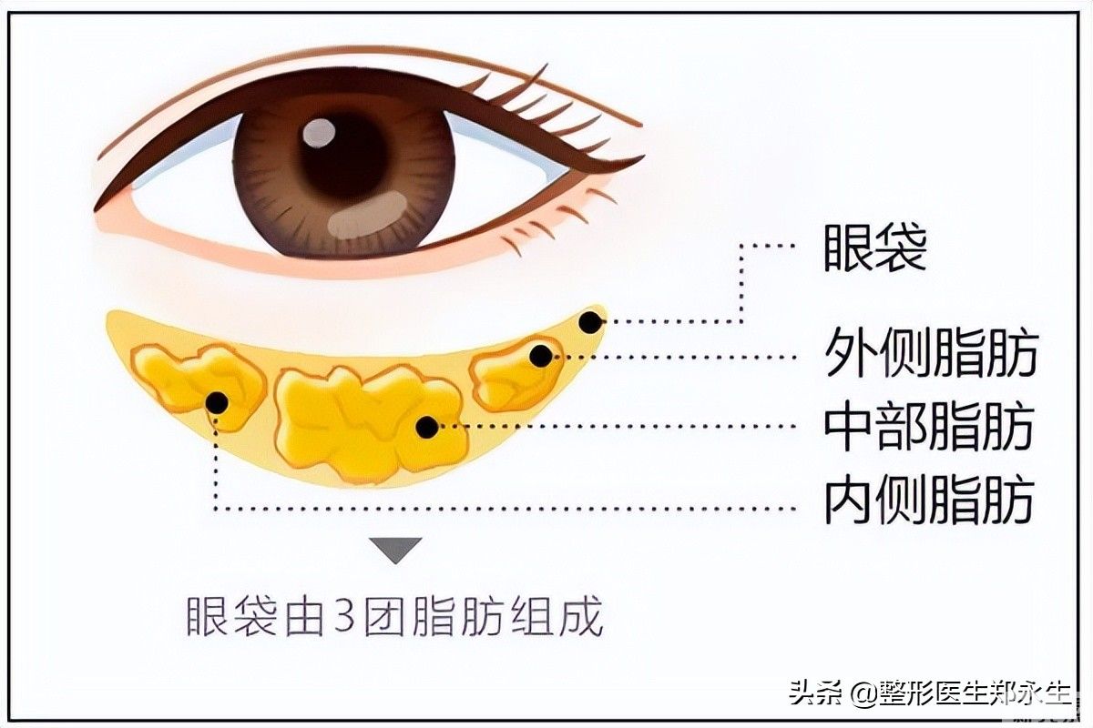 科普|眼袋一般分为假性眼袋和真性眼袋 图片-2