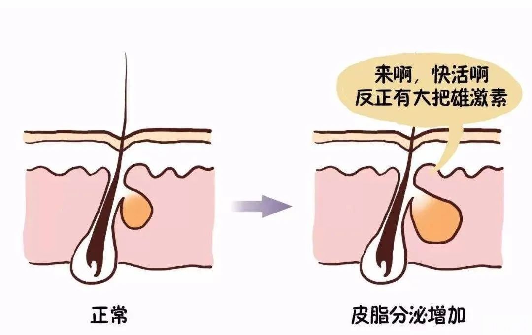 都过了青春期，为什么还是频繁长痘? 图片-4