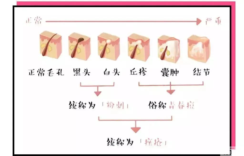 都过了青春期，为什么还是频繁长痘? 图片-5