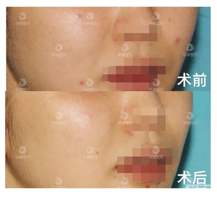 都过了青春期，为什么还是频繁长痘? 图片-14