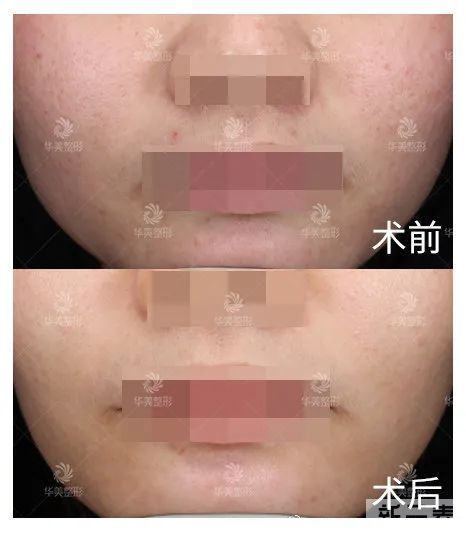 都过了青春期，为什么还是频繁长痘? 图片-11