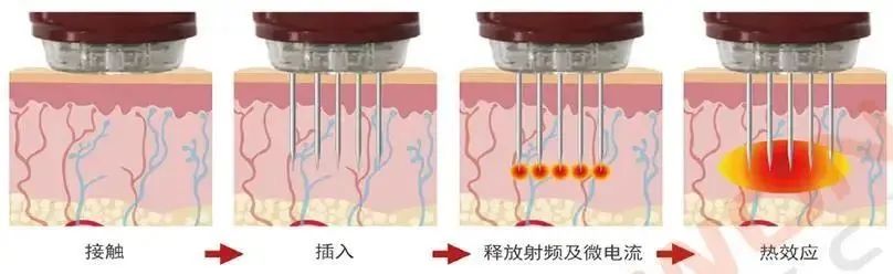 都过了青春期，为什么还是频繁长痘? 图片-13