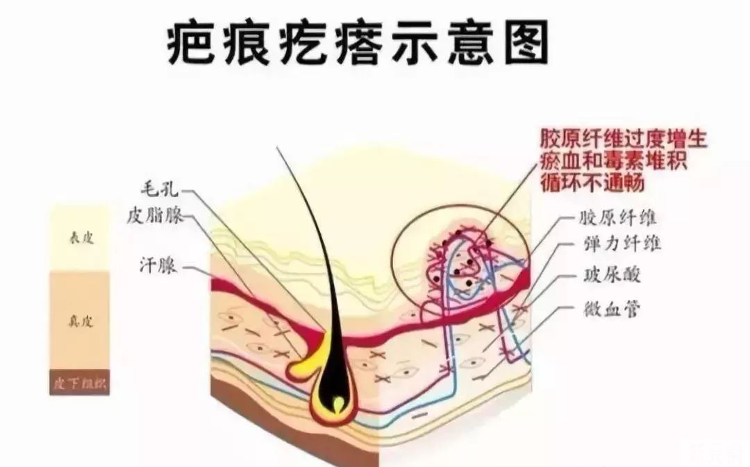 如果你身上的疤痕也是这样，那你要注意了 图片-3