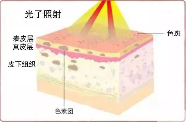 做完光子嫩肤，皮肤会不会变薄? 图片-3