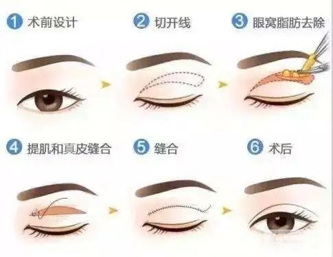 都是同一天做的双眼皮，为啥她恢复这么快? 图片-7