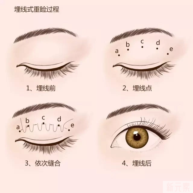 都是同一天做的双眼皮，为啥她恢复这么快? 图片-5