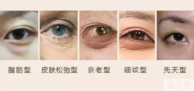 去眼袋做什么切口好?大部分人都是选ta ! 图片-5