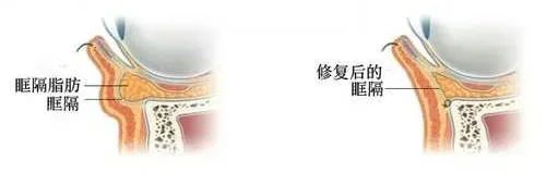 去眼袋做什么切口好?大部分人都是选ta ! 图片-9