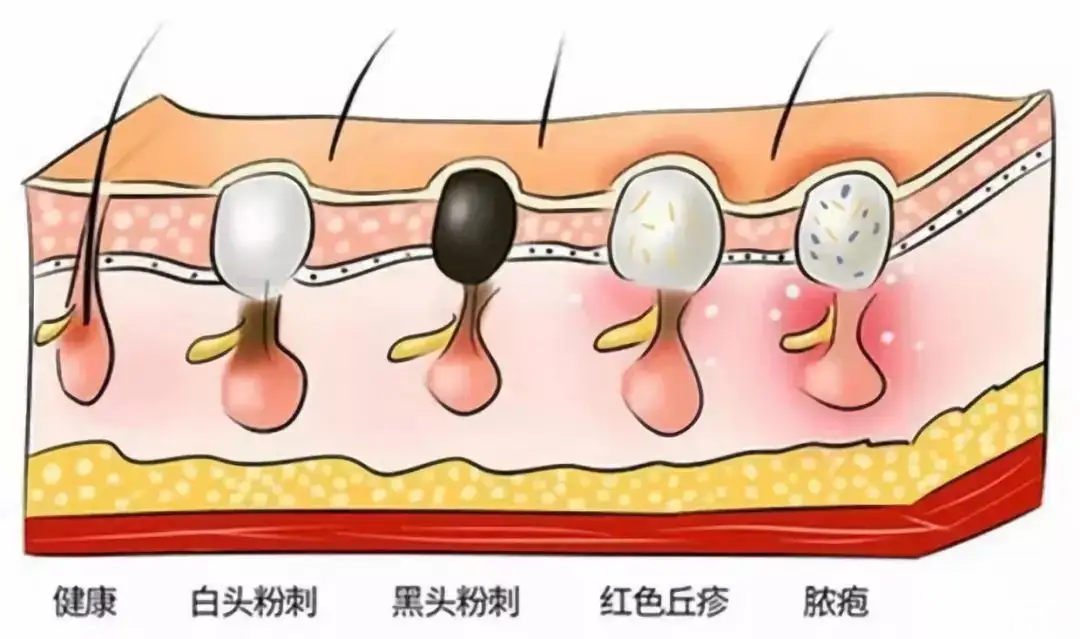 痘痘反反复复怎么办?难道是脸不干净? 图片-8