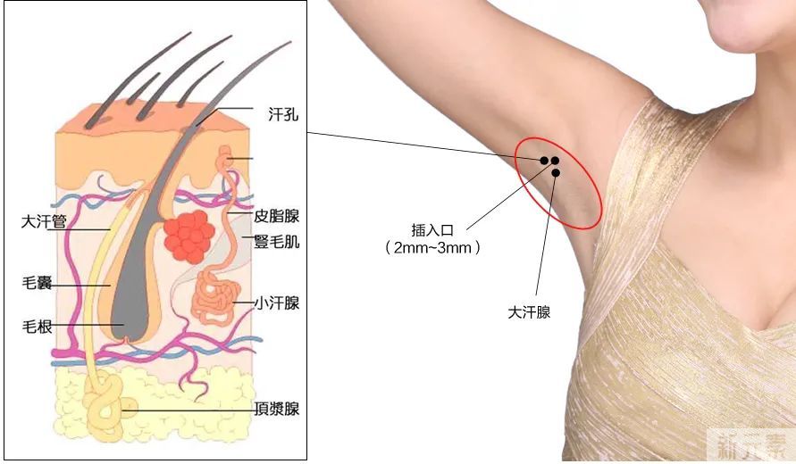 除腋臭 | 为防夏季尴尬，我可是找遍了方法! 图片-7