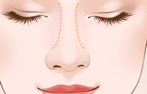 硅胶隆鼻和膨体隆鼻有啥区别? 图片-6