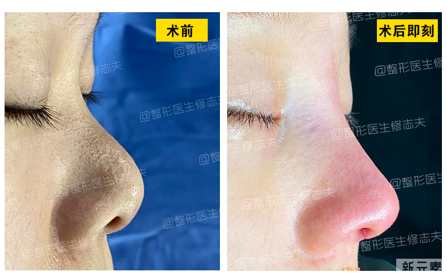 问题鼻型盘点，看看有没有你的同款? 图片-11