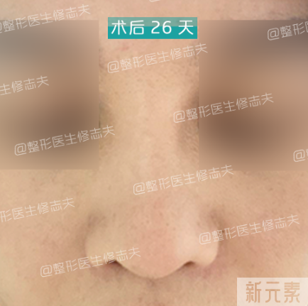 问题鼻型盘点，看看有没有你的同款? 图片-23