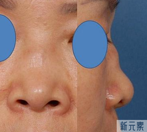 问题鼻型盘点，看看有没有你的同款? 图片-24