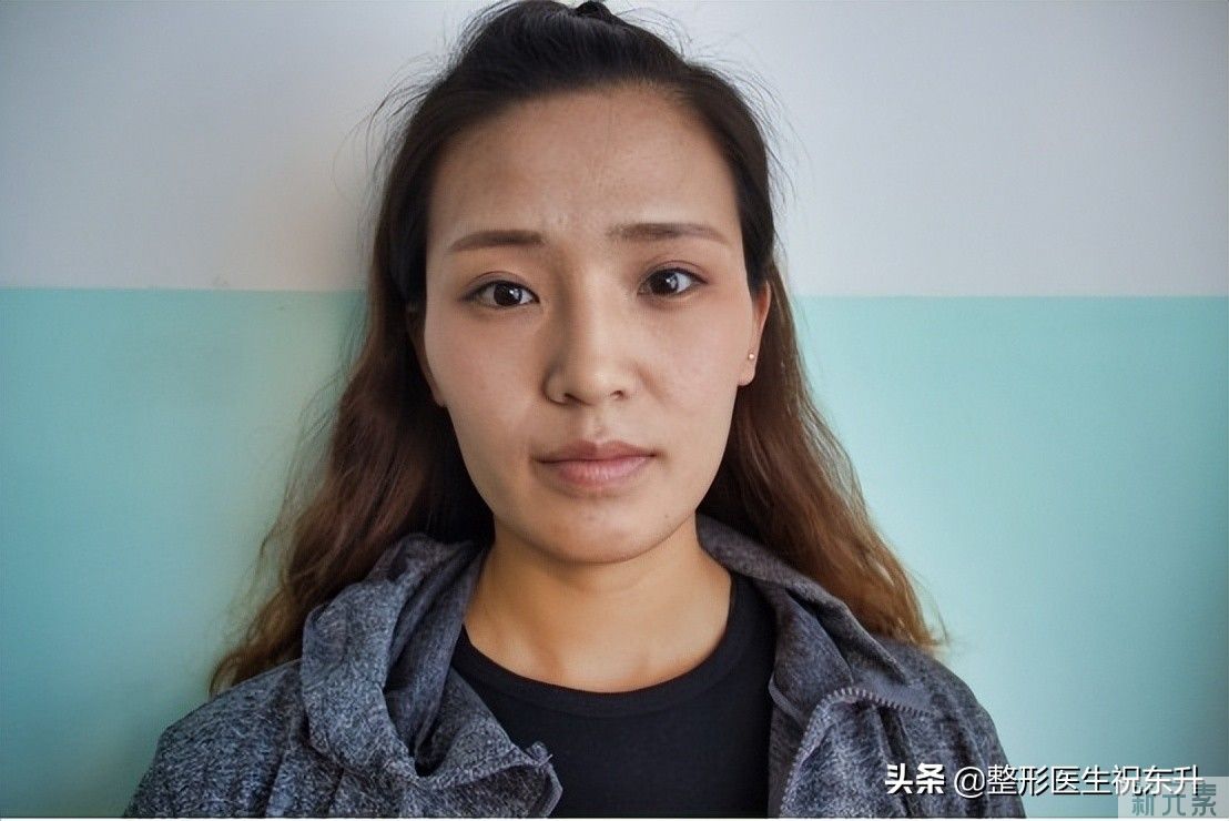 41岁做全脸脂肪填充，全程实拍大公开，这娃娃脸真“绝”了 图片-1